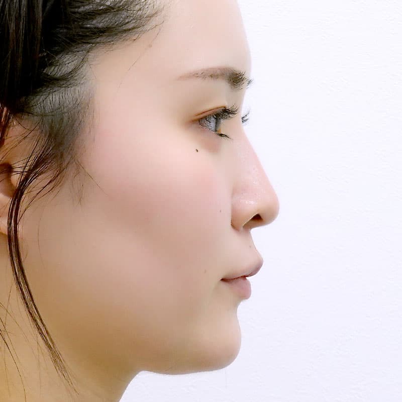 20250831_St20250831_tanaka_hyaluronic lips eye bags nose　②After